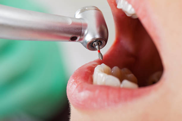 Best Lost Filling or Crown Replacement in Renton, WA